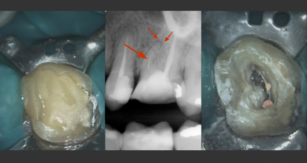 Zleva: zub s provizorní výplní; RTG snímek s lokalizací zalomeného nástroje (velká šipka) a zánětlivého ložiska (malá šipka); příprava vstupu do inkriminovaného kanálku